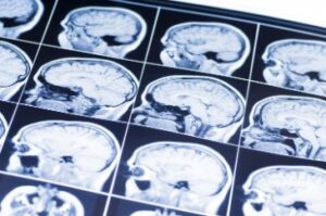 Traumatic Brain Injury Case Value