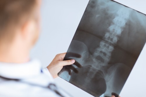 Workers' Compensation for Spinal Cord Injuries: Your Rights in South Carolina